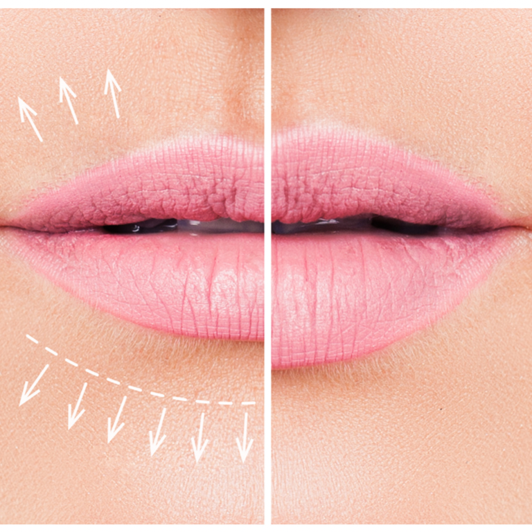 LipLase laserowe powiększanie ust